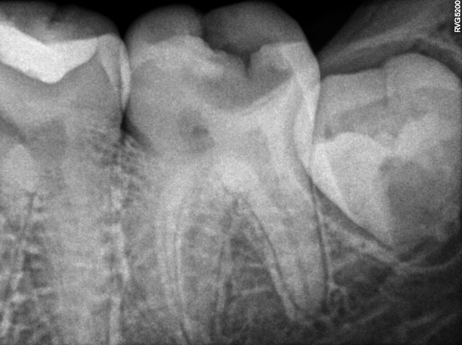 Dental X-ray